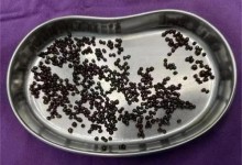 女子体内取出几百颗结石如鱼子酱 胆内塞得满满当当-融党建互动平台