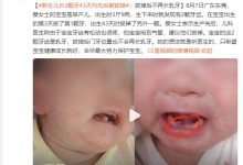 早产儿出生罕见长2颗牙先后被拔掉 怕宝宝呛到气管-融党建互动平台