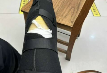 女子划桨板被摩托艇故意撞倒2次 致全身多处水肿-融党建互动平台