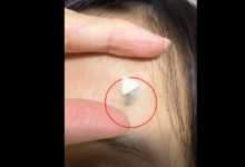 女生手术取出被戳进额头20年铅笔芯 网友被勾起童年回忆晒同款-融党建互动平台