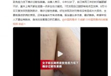 女子称熬夜致免疫力低下确诊紫癜 每天都在凌晨1点才睡-融党建互动平台