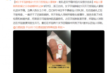 女子手指肿胀21天开刀发现仙人掌刺：刺扎进关节缝中拍片没显示出来-融党建互动平台