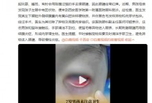 7岁男孩未注意卫生致猫毛入眼后手术取出 导致结膜炎症-融党建互动平台