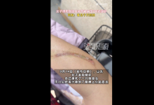 女子捏死隐翅虫手臂被腐蚀7天还没好 网友：会反复溃烂-融党建互动平台