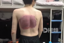 男生泡澡后背被排水口吸出大片淤青：感觉大脑缺氧-融党建互动平台