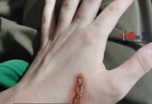 男子拍死隐翅虫多处溃烂5天未愈 身体出现多处红印-融党建互动平台