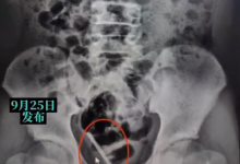 10岁男童将体温计插入尿道不慎折断 网友：建议加强性教育-融党建互动平台