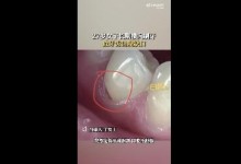 27岁女子长期横向刷牙致牙齿缺损 网友：一颗800块-融党建互动平台