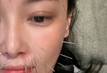 张馨予针灸是为了治疗长痘 回应在脸上做针灸原因-融党建互动平台