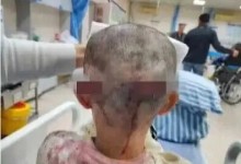 安徽7岁女童被恶犬撕咬致毁容 家属称狗主人至今没赔偿-融党建互动平台