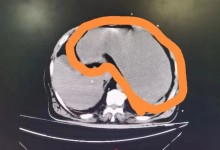 80岁老人胃被未消化食物撑大2倍 自称不想给儿女添麻烦-融党建互动平台