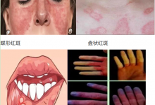 红斑狼疮被称“不死的癌症” 患红斑狼疮什么症状图片-融党建互动平台