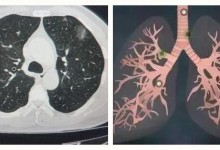 37岁男子肺部发现557个结节 医生也大为震撼-融党建互动平台