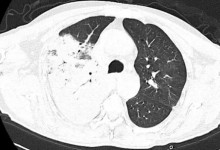 夫妻宰杀活鸭被抓伤住进ICU 得了鹦鹉热衣原体感染-融党建互动平台