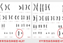 超雄综合征的孩子就是天生坏种吗 超雄综合征会遗传吗-融党建互动平台