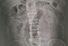 男子连吃3根生香蕉致肠梗阻 网友：还是火龙果好使-融党建互动平台