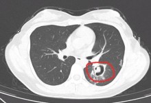 杭州姑娘清理发霉衣柜肺部长霉菌 清理时没做好防护-融党建互动平台