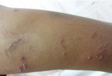 女子把隐翅虫当蚊子拍死差点毁容 医生：千万不要拍打-融党建互动平台