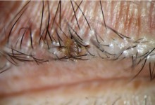 大爷不讲卫生致阴虱寄生到眼部 这个坏习惯赶紧改-融党建互动平台