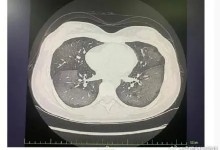 女子吸入防晒喷雾变白肺 医生提醒：不能直接对着脸喷-融党建互动平台