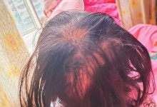 3岁女童突然脱发 查出铊中毒 医生：毒性高于砒霜-融党建互动平台